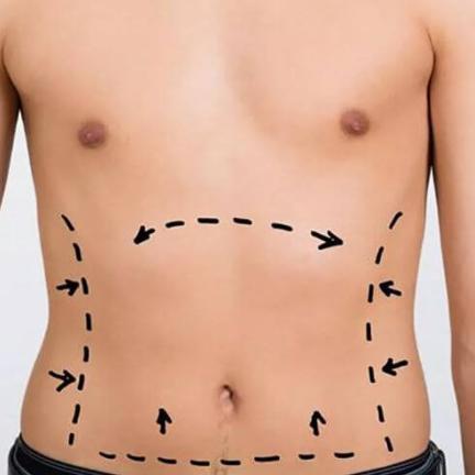 Lipoaspiración